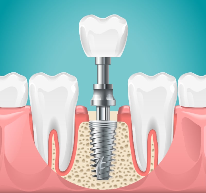 https://plantzasdental.gr/wp-content/uploads/2023/12/emfyteuma.jpg